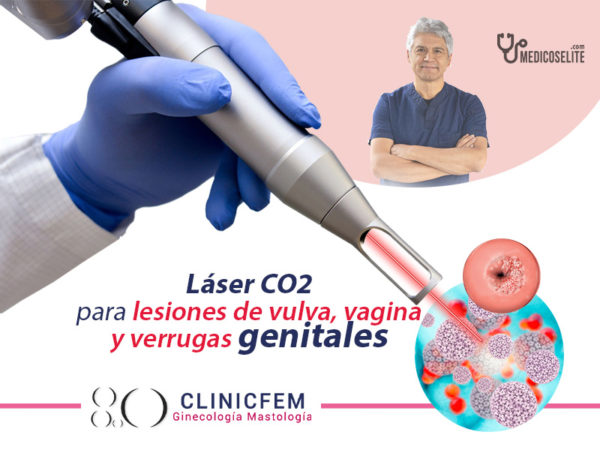 Tratamiento Papiloma Quito con láser VPH Efectivo Clinicfem